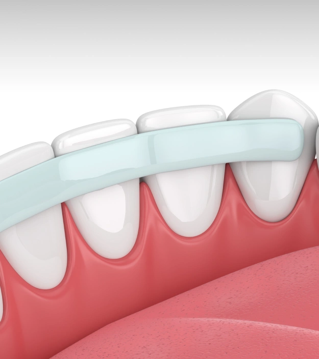 Illustration of dental bonding used to repair and reshape teeth at Cariboo Choice Dental.