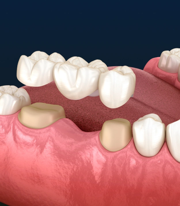Dental bridge replacing missing teeth and restoring smile function