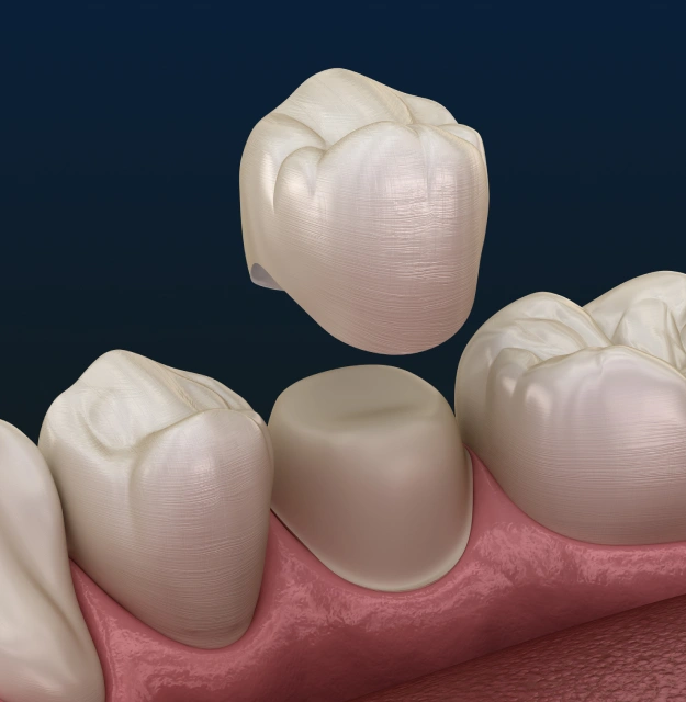 Dental crowns used to restore damaged teeth