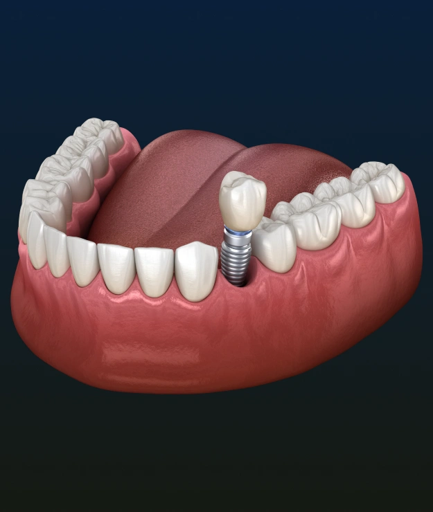 Dental implant restoration replacing a missing tooth with a natural-looking result
