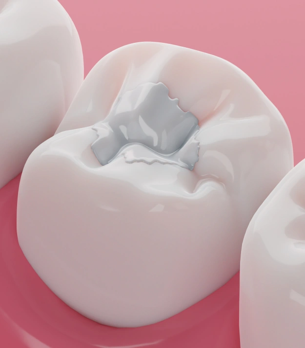 Tooth-colored filling restoring a cavity with a natural appearance